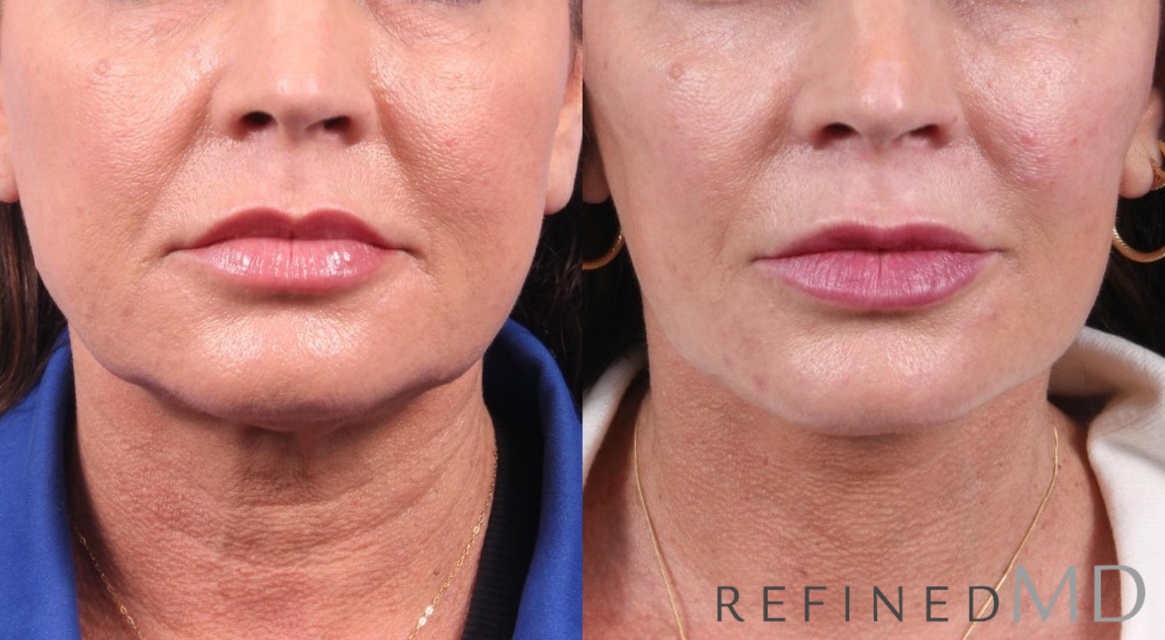 Before & After Facelift Case 1068 View 1 View in Los Gatos & San Jose, CA