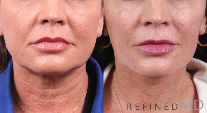 Before & After Facelift Case 1068 View 1 View in Los Gatos & San Jose, CA
