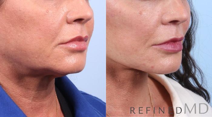 Before & After Facelift Case 1068 View 2 View in Los Gatos & San Jose, CA