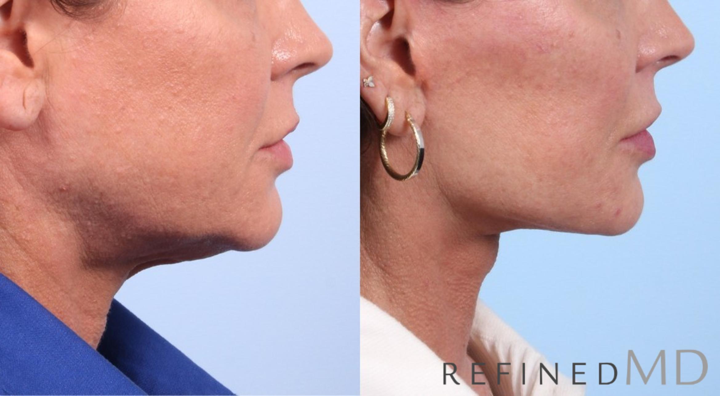 Before & After Facelift Case 1068 View 3 View in Los Gatos & San Jose, CA
