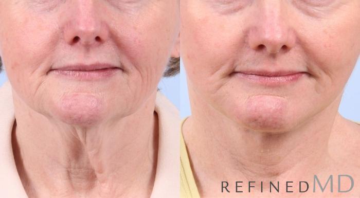 Before & After Facelift Case 1069 View 1 View in Los Gatos & San Jose, CA