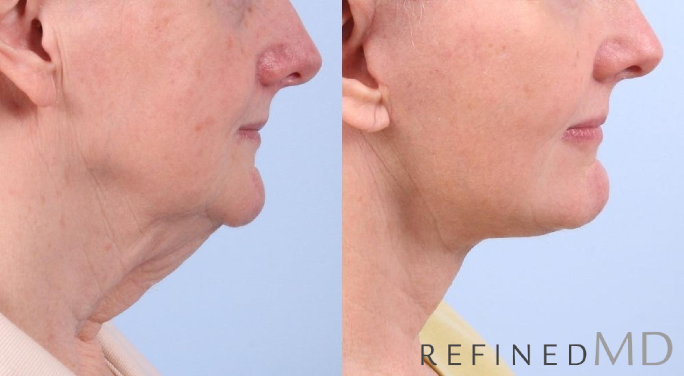 Before & After Facelift Case 1069 View 2 View in Los Gatos & San Jose, CA
