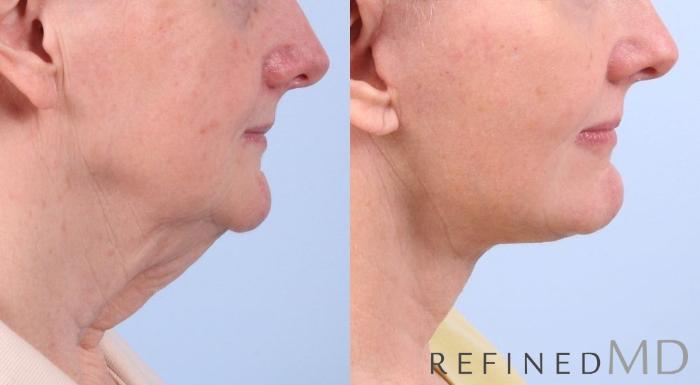 Before & After Facelift Case 1069 View 2 View in Los Gatos & San Jose, CA