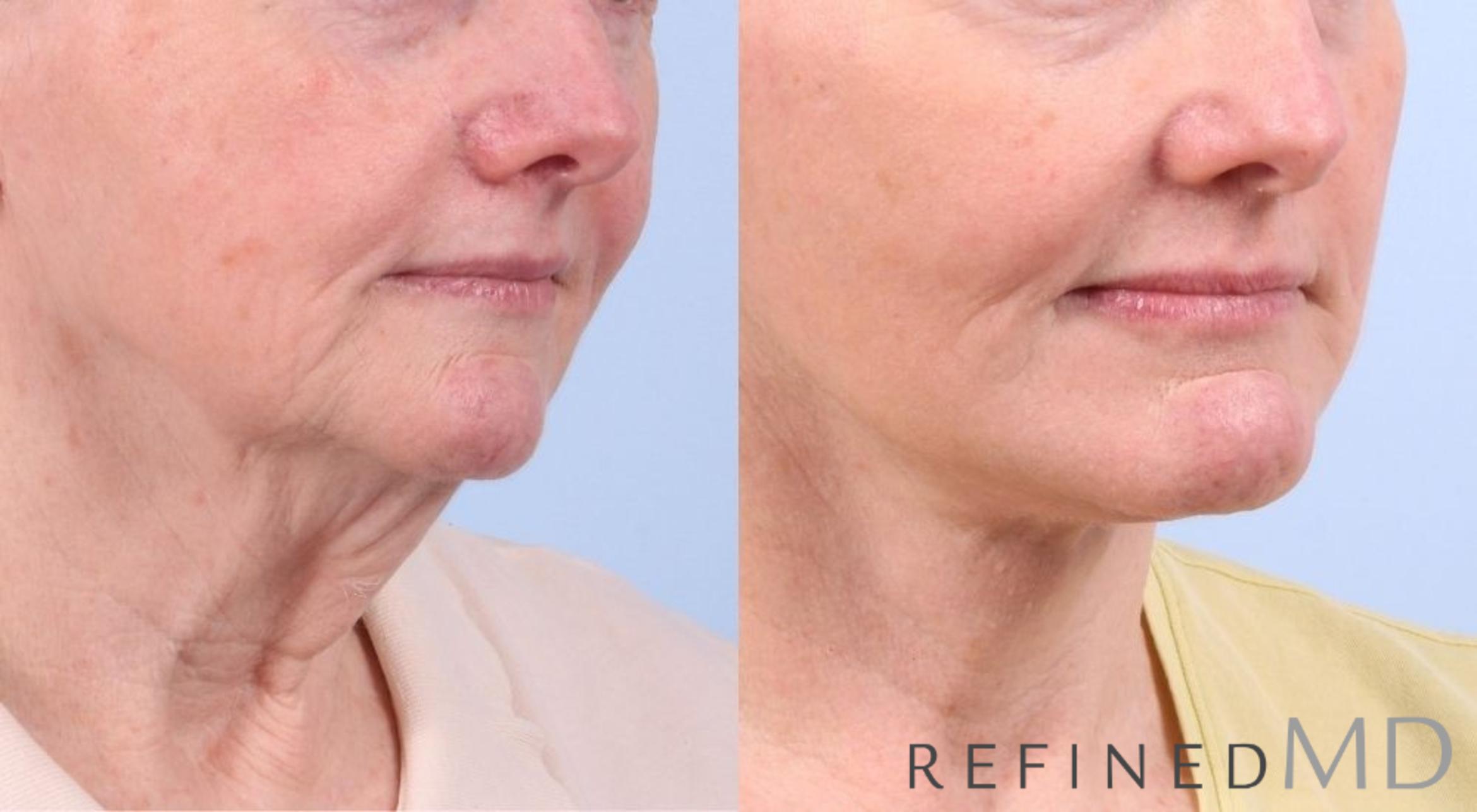 Before & After Facelift Case 1069 View 3 View in Los Gatos & San Jose, CA