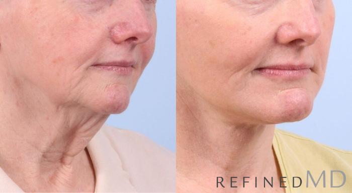 Before & After Facelift Case 1069 View 3 View in Los Gatos & San Jose, CA
