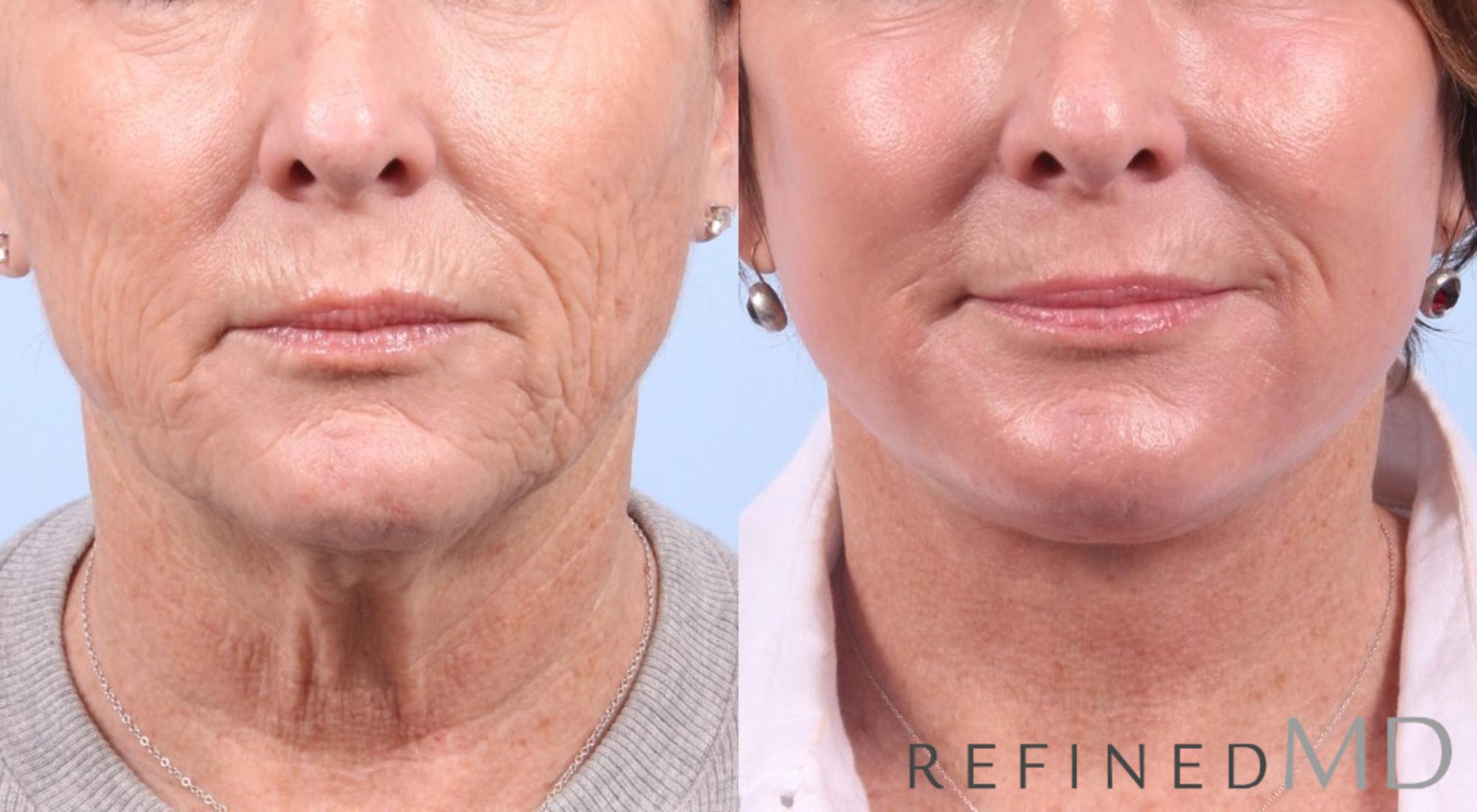 Before & After Facelift Case 1070 View 1 View in Los Gatos & San Jose, CA
