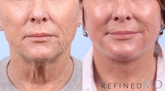 Before & After Facelift Case 1070 View 1 View in Los Gatos & San Jose, CA