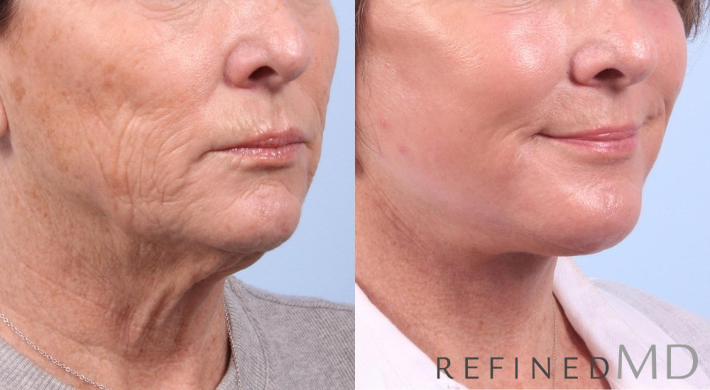 Before & After Facelift Case 1070 View 2 View in Los Gatos & San Jose, CA