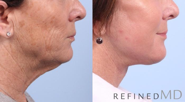 Before & After Facelift Case 1070 View 3 View in Los Gatos & San Jose, CA