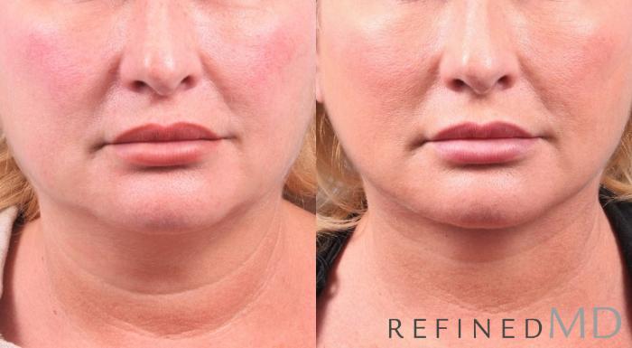 Before & After Facelift Case 1071 View 1 View in Los Gatos & San Jose, CA