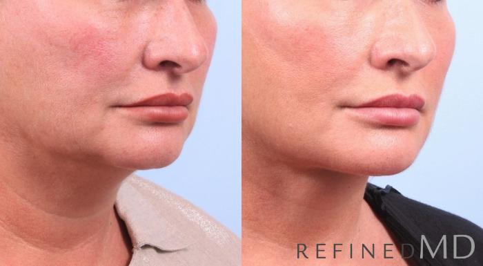 Before & After Facelift Case 1071 View 2 View in Los Gatos & San Jose, CA