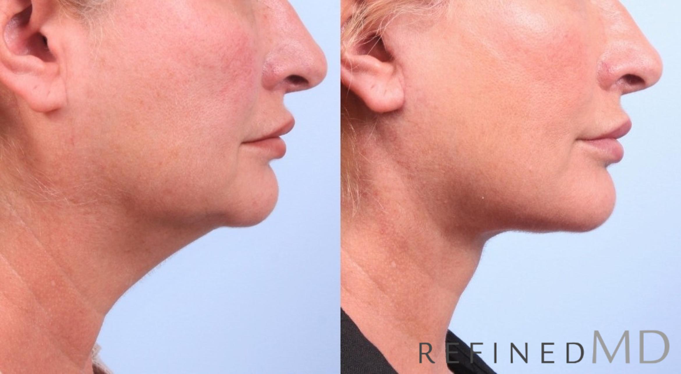 Before & After Facelift Case 1071 View 3 View in Los Gatos & San Jose, CA