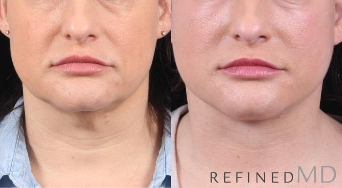 Before & After Facelift Case 1072 View 1 View in Los Gatos & San Jose, CA