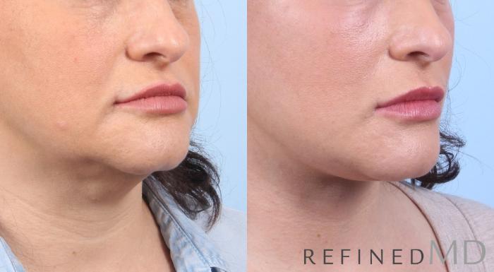 Before & After Facelift Case 1072 View 2 View in Los Gatos & San Jose, CA