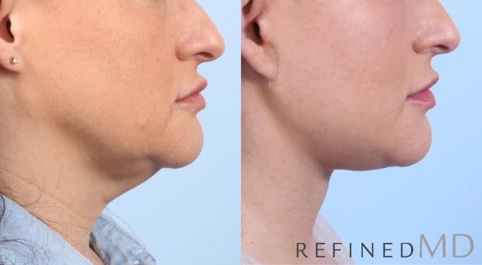 Before & After Facelift Case 1072 View 3 View in Los Gatos & San Jose, CA