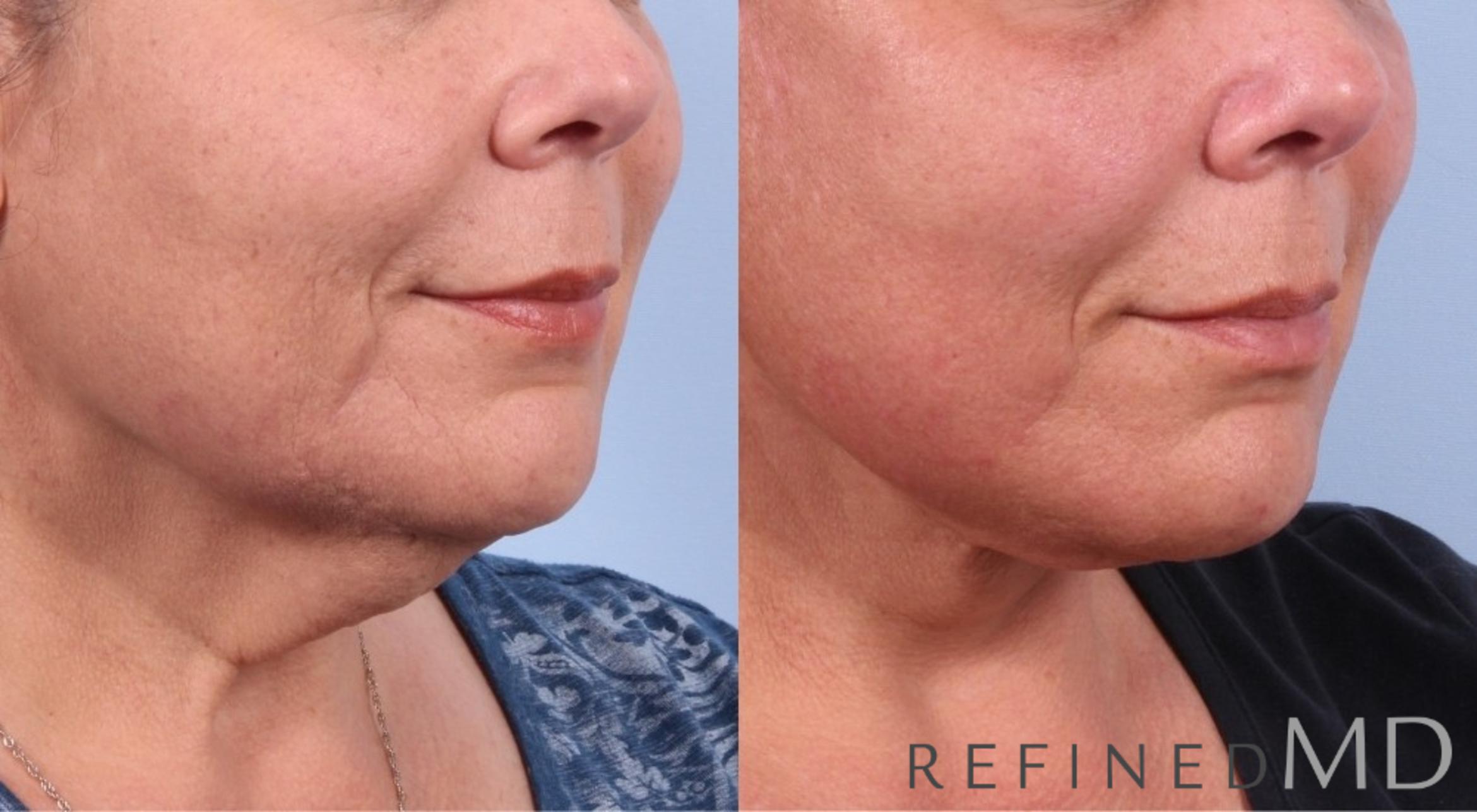 Before & After Facelift Case 1073 View 1 View in Los Gatos & San Jose, CA