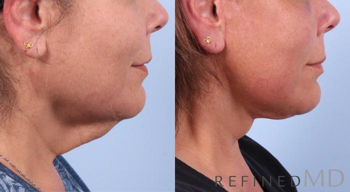 Before & After Facelift Case 1073 View 2 View in Los Gatos & San Jose, CA