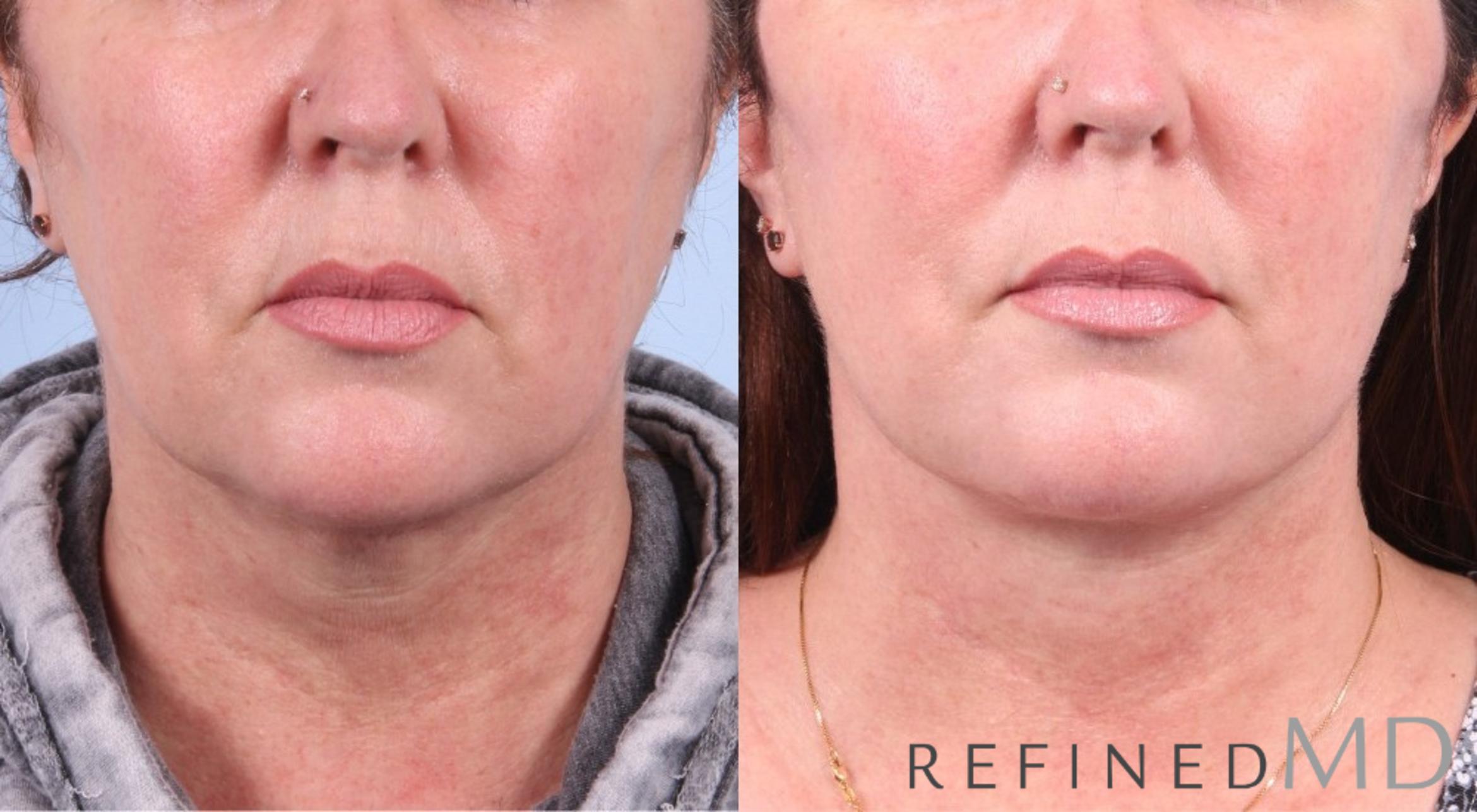 Before & After Facelift Case 1074 View 1 View in Los Gatos & San Jose, CA