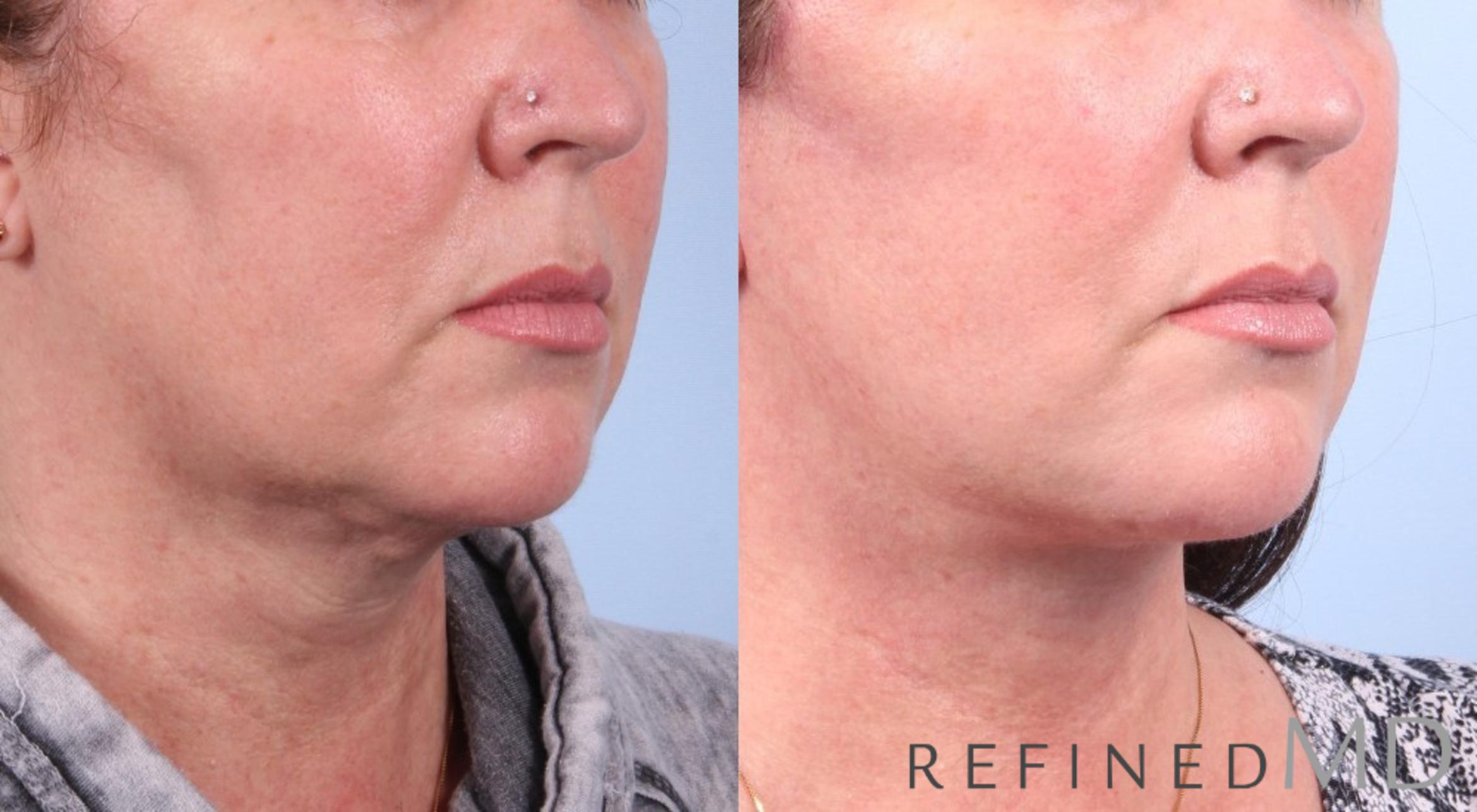 Before & After Facelift Case 1074 View 2 View in Los Gatos & San Jose, CA