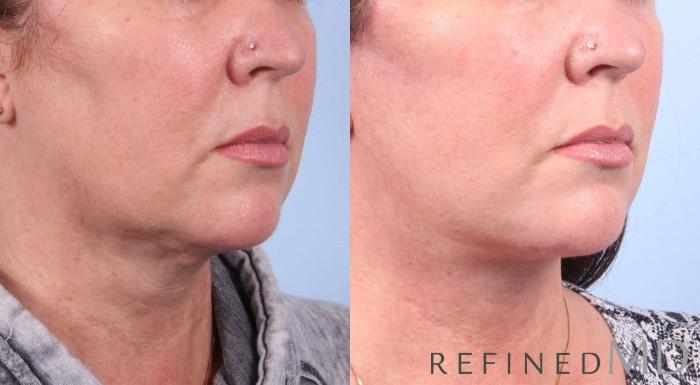 Before & After Facelift Case 1074 View 2 View in Los Gatos & San Jose, CA
