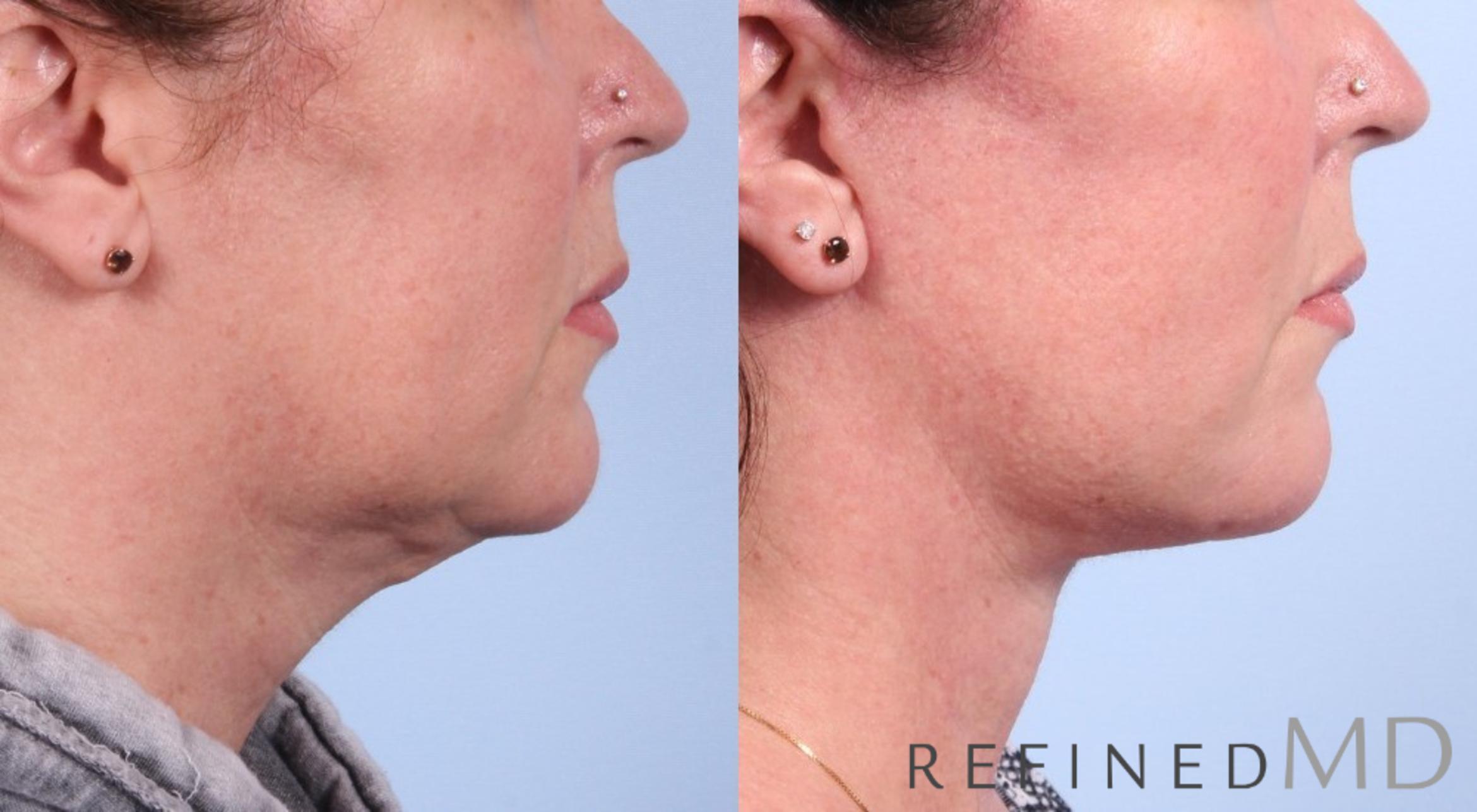 Before & After Facelift Case 1074 View 3 View in Los Gatos & San Jose, CA