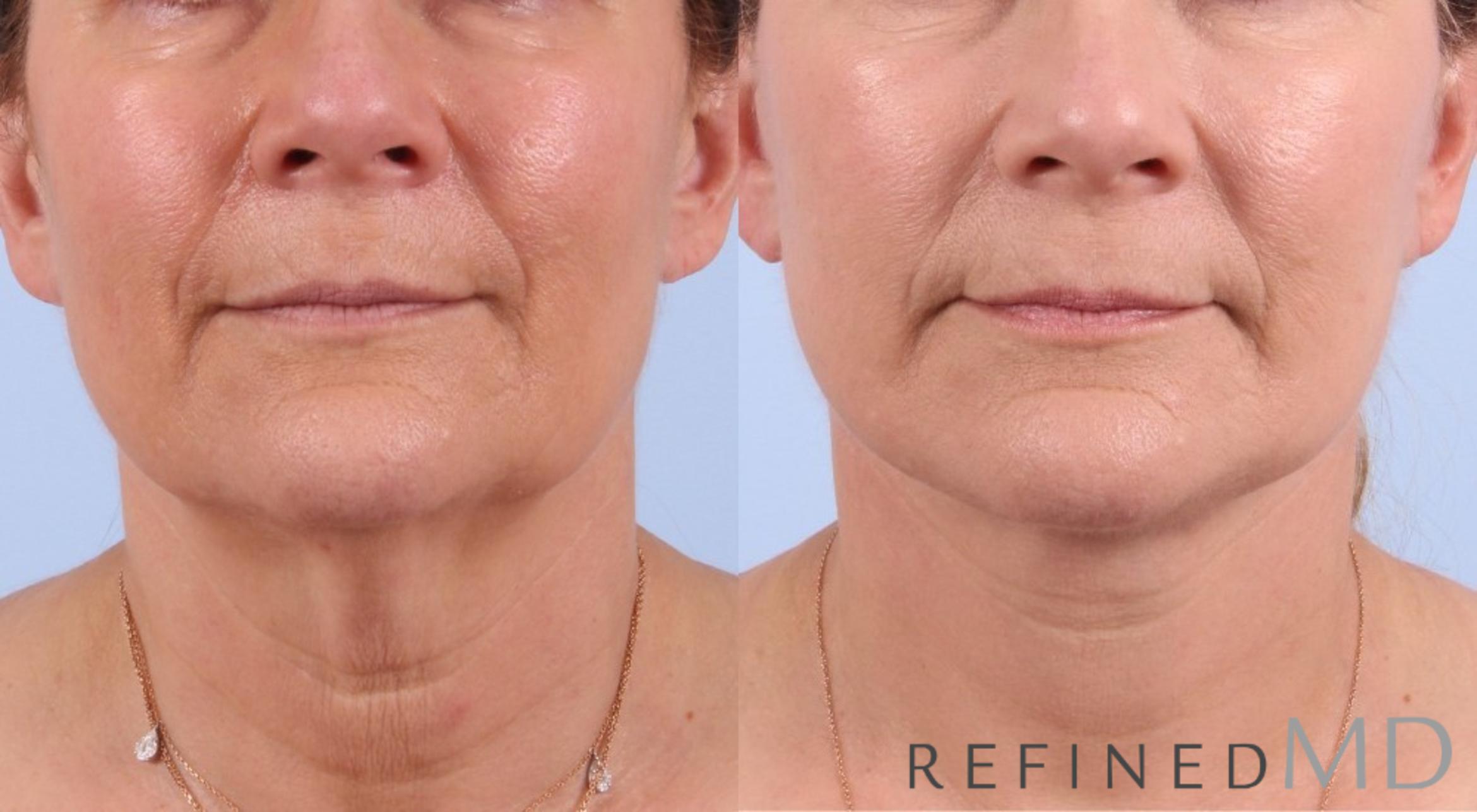Before & After Facelift Case 1075 View 1 View in Los Gatos & San Jose, CA