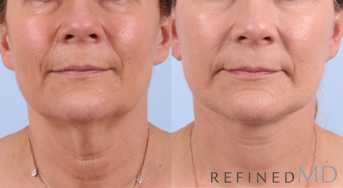 Before & After Facelift Case 1075 View 1 View in Los Gatos & San Jose, CA