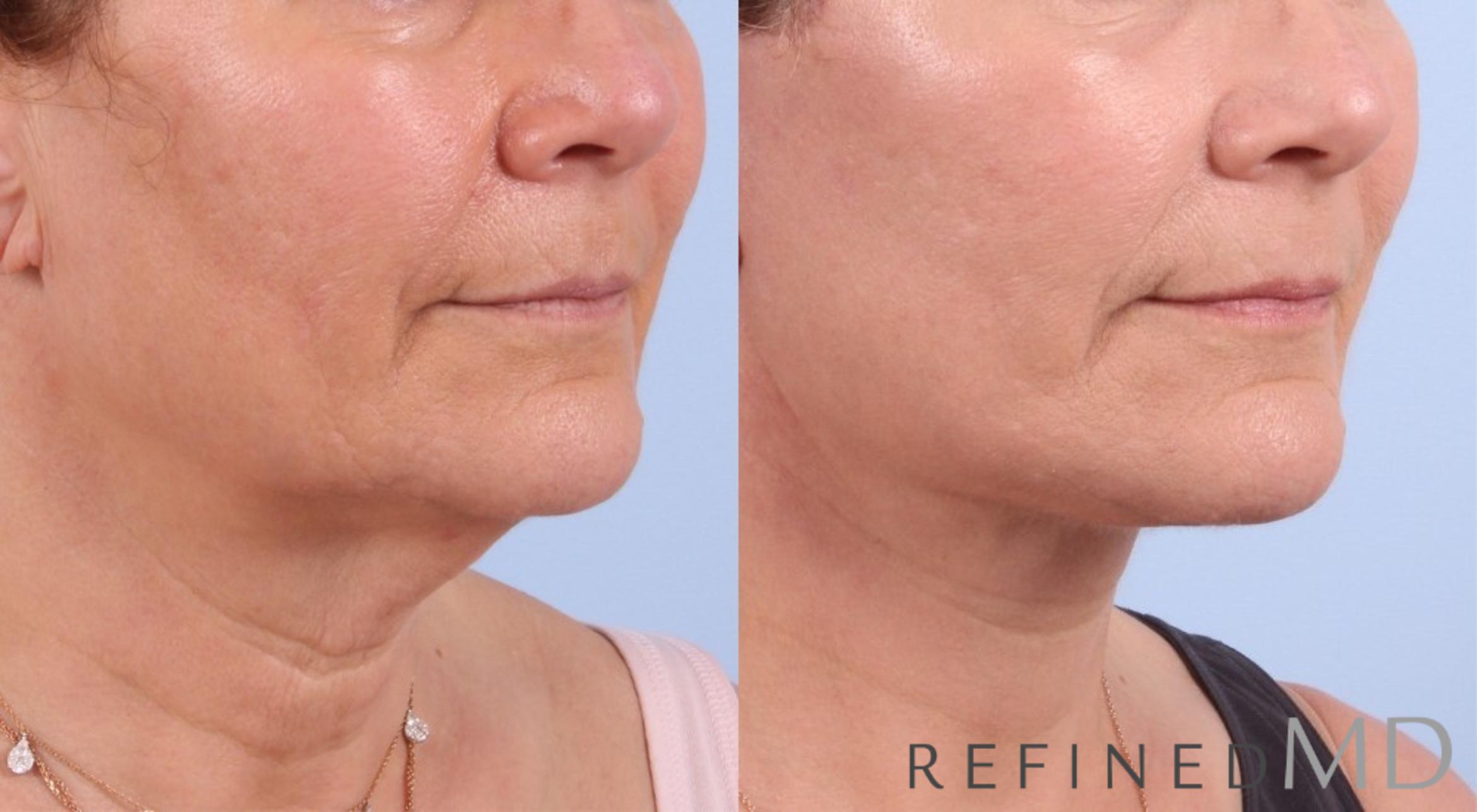 Before & After Facelift Case 1075 View 2 View in Los Gatos & San Jose, CA