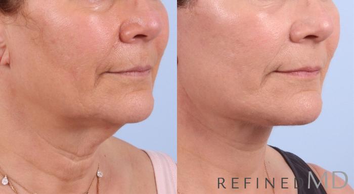 Before & After Facelift Case 1075 View 2 View in Los Gatos & San Jose, CA