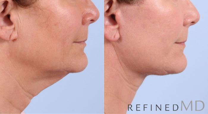 Before & After Facelift Case 1075 View 3 View in Los Gatos & San Jose, CA