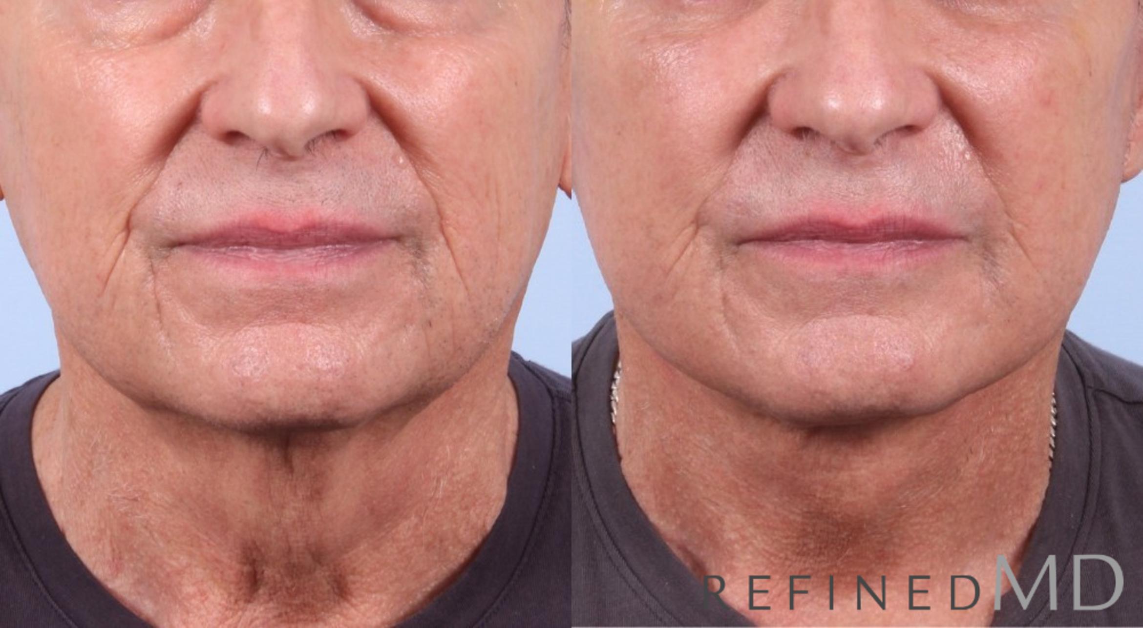 Before & After Facelift Case 1076 View 1 View in Los Gatos & San Jose, CA