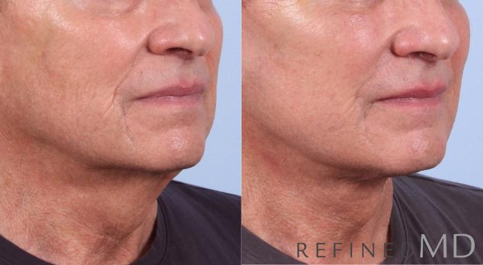 Before & After Facelift Case 1076 View 2 View in Los Gatos & San Jose, CA