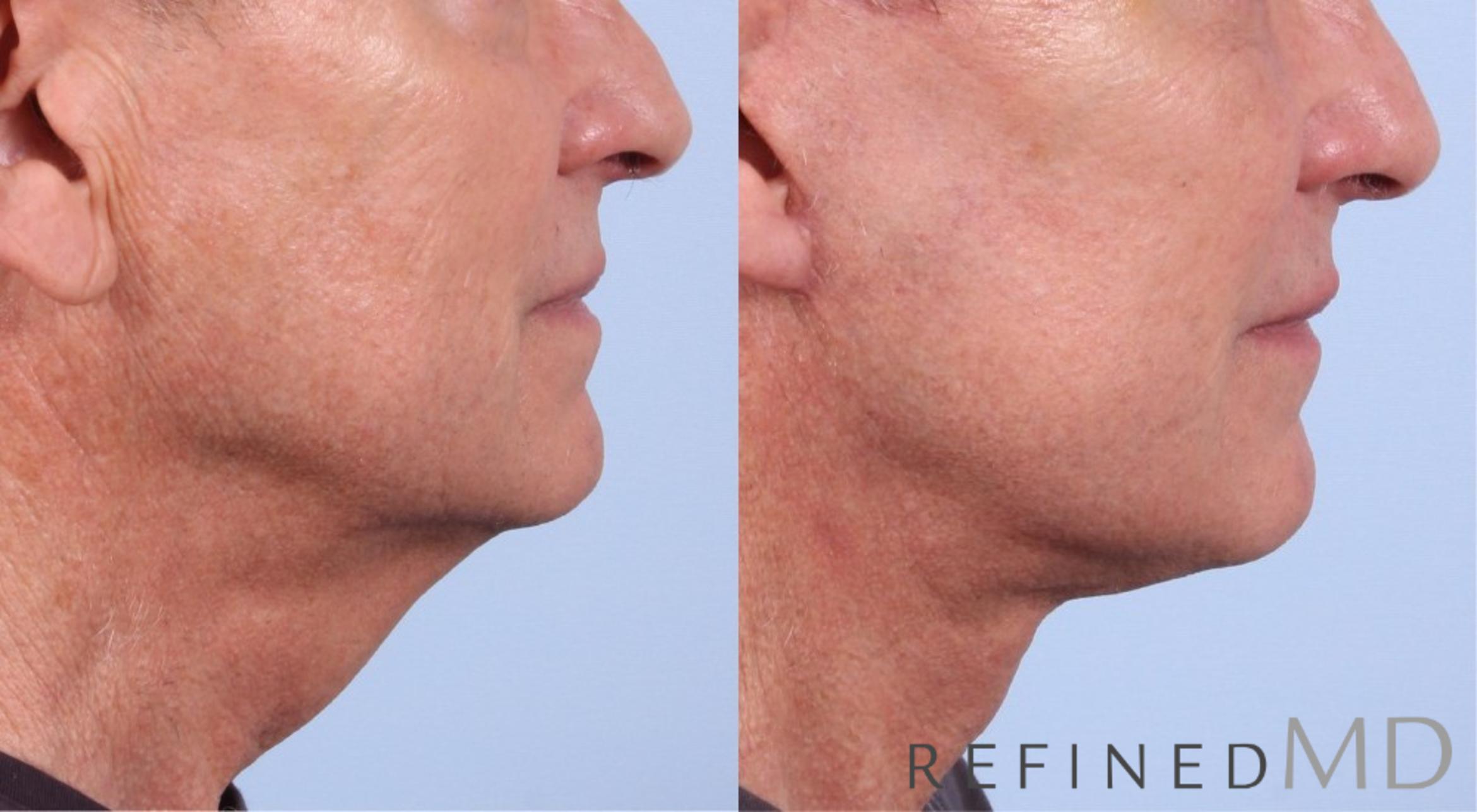 Before & After Facelift Case 1076 View 3 View in Los Gatos & San Jose, CA