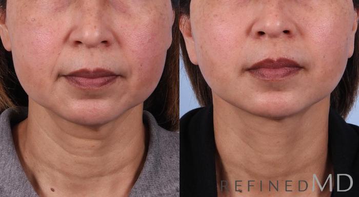 Before & After Facelift Case 1077 View 1 View in Los Gatos & San Jose, CA