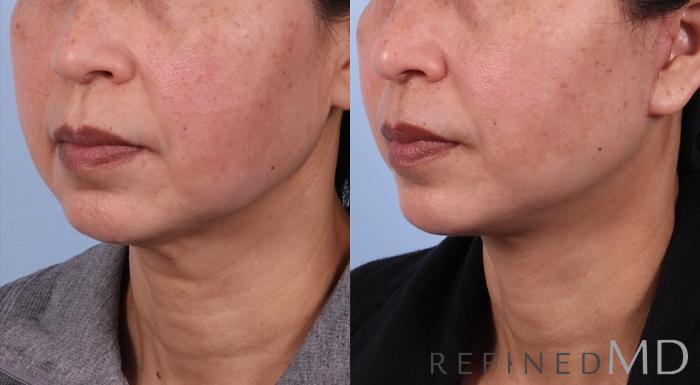 Before & After Facelift Case 1077 View 2 View in Los Gatos & San Jose, CA