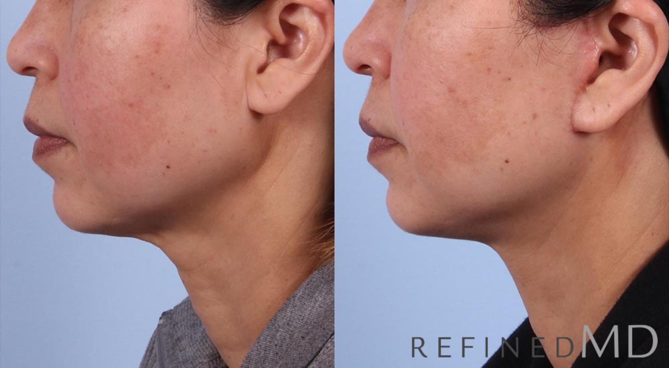 Before & After Facelift Case 1077 View 3 View in Los Gatos & San Jose, CA