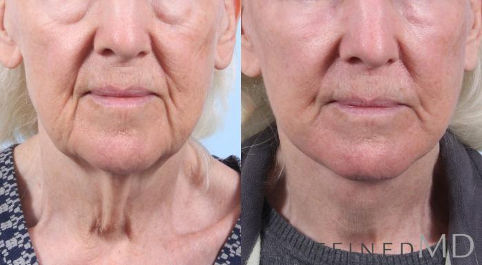 Before & After Facelift Case 1078 View 1 View in Los Gatos & San Jose, CA