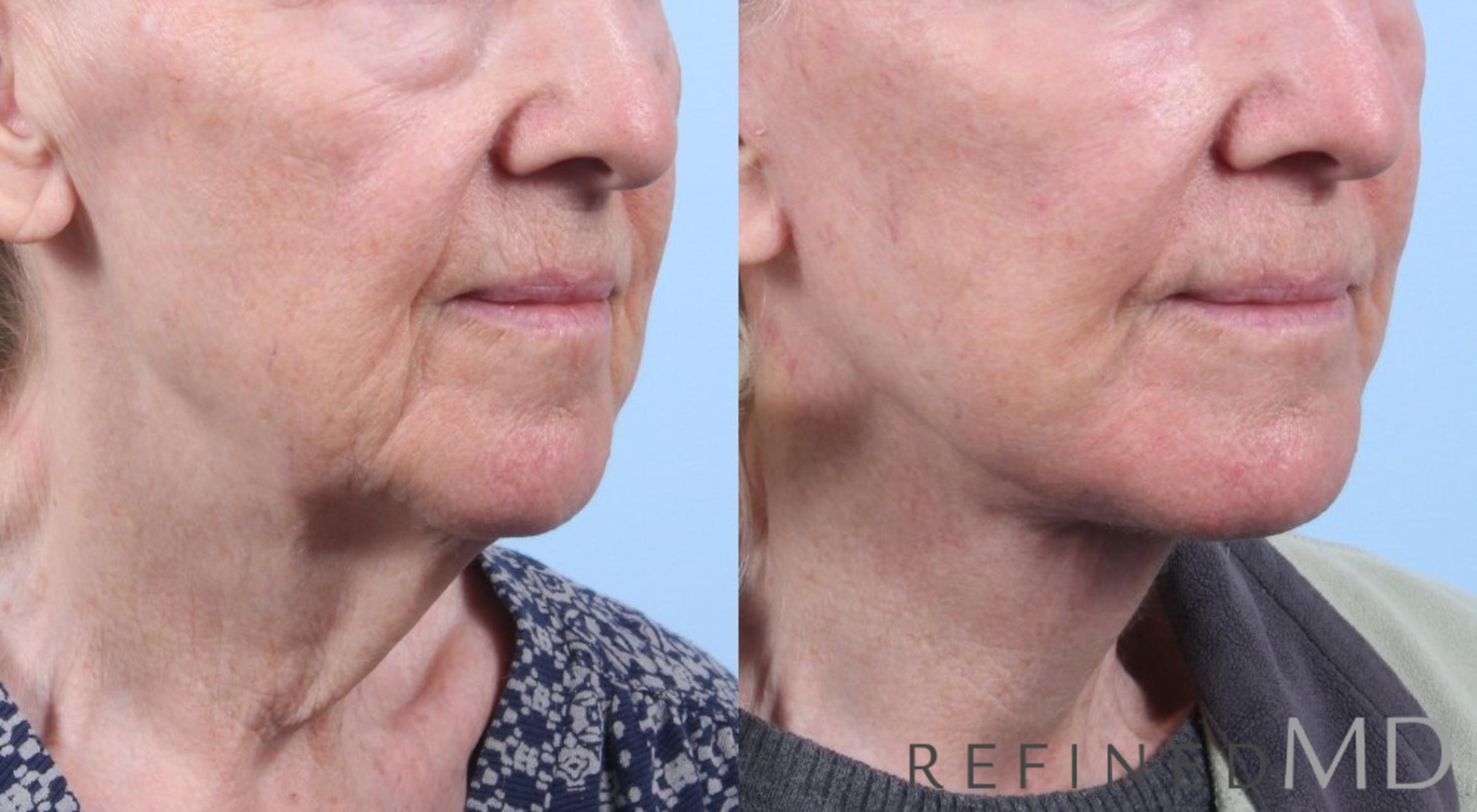 Before & After Facelift Case 1078 View 2 View in Los Gatos & San Jose, CA