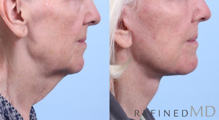 Before & After Facelift Case 1078 View 3 View in Los Gatos & San Jose, CA