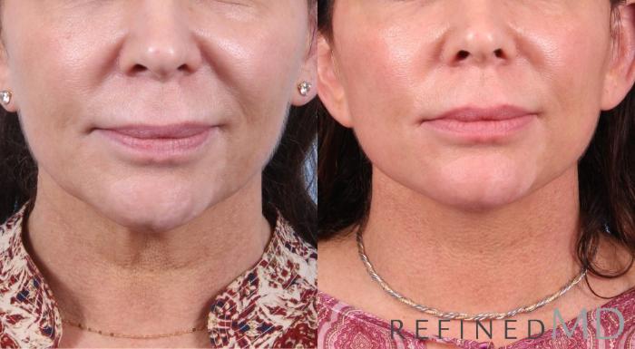 Before & After Facelift Case 1079 View 1 View in Los Gatos & San Jose, CA