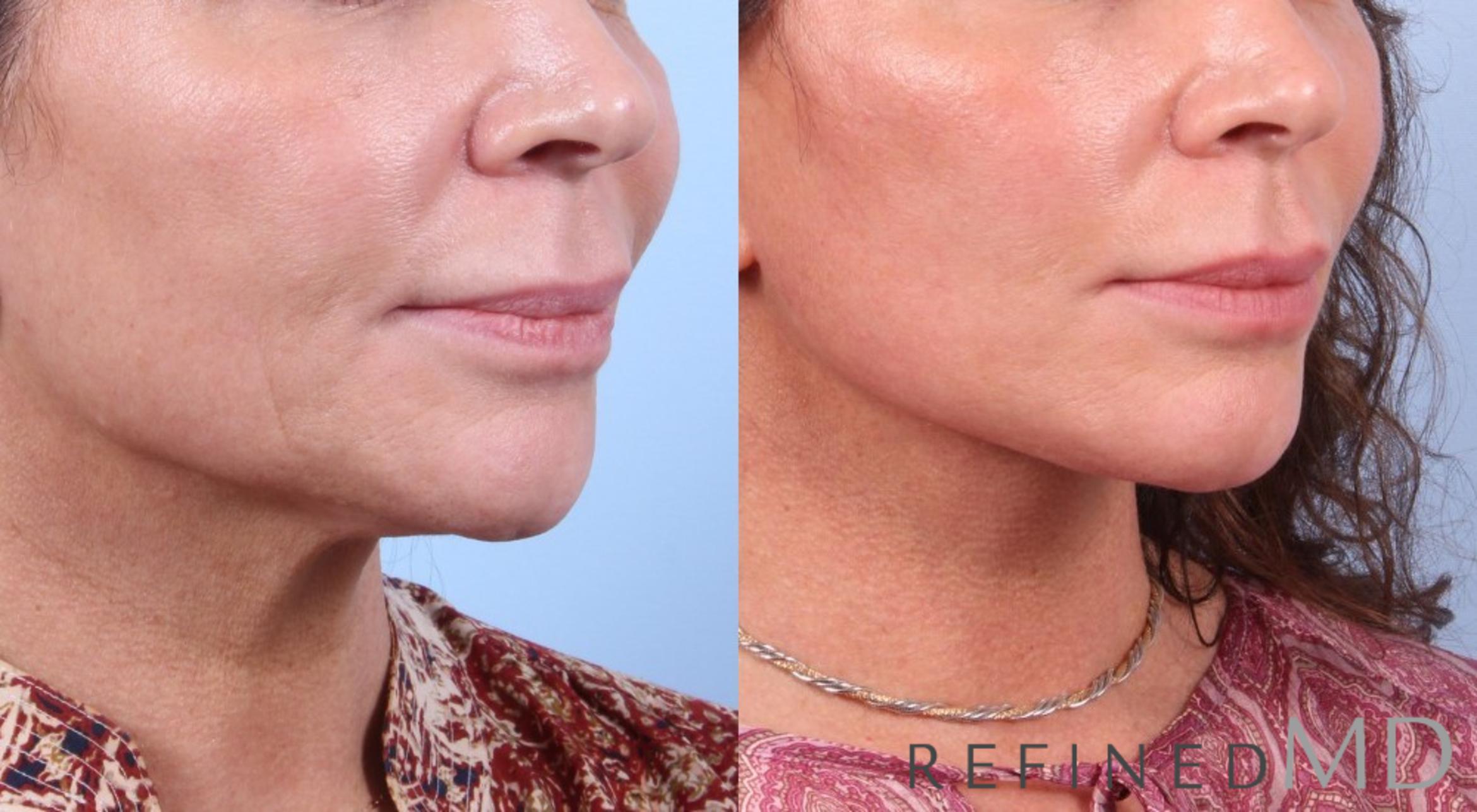 Before & After Facelift Case 1079 View 2 View in Los Gatos & San Jose, CA