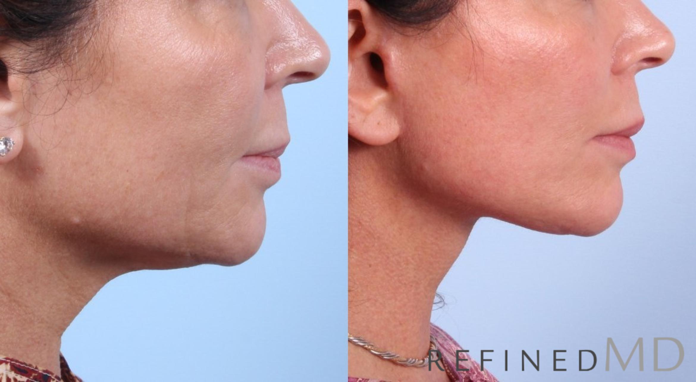 Before & After Facelift Case 1079 View 3 View in Los Gatos & San Jose, CA