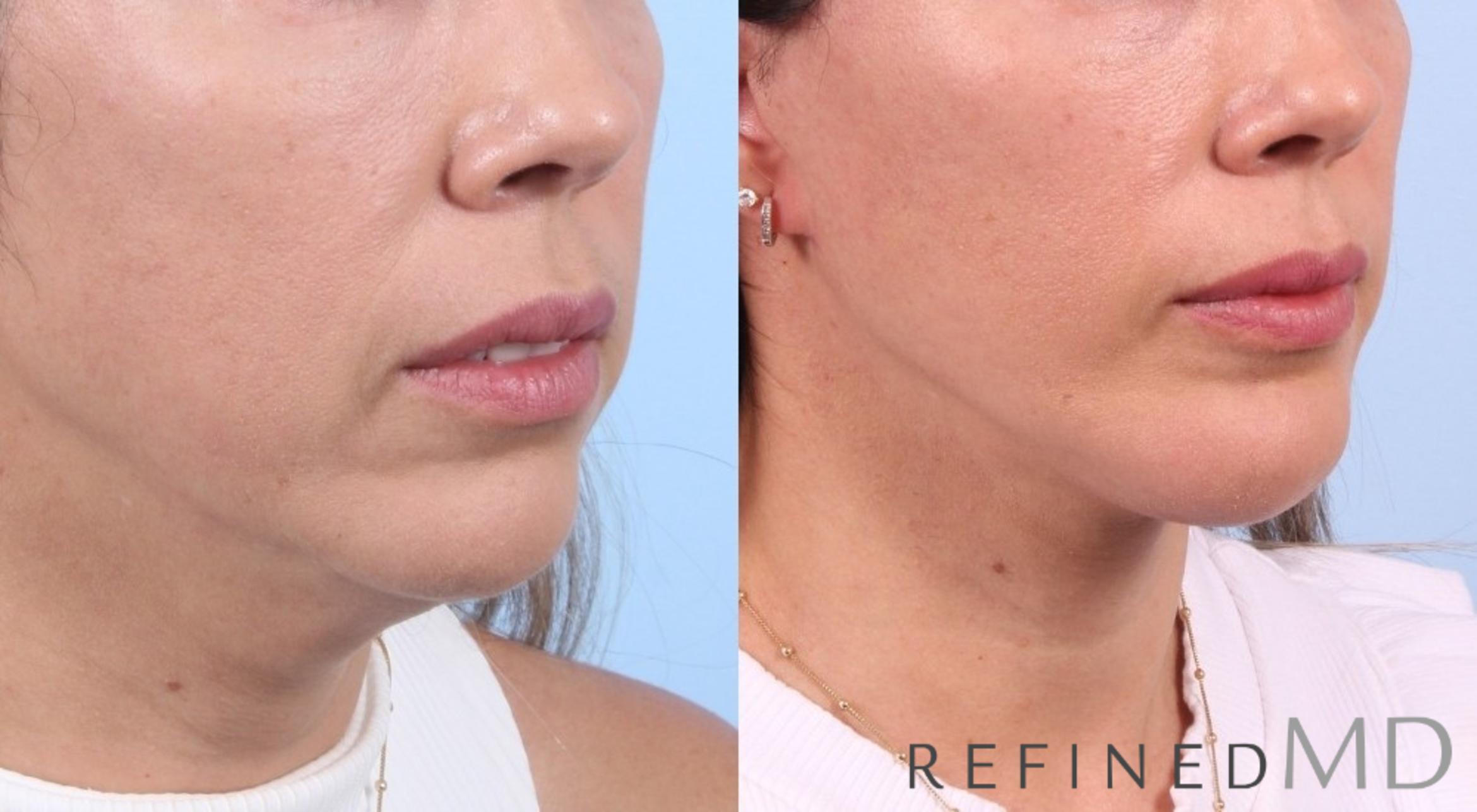 Before & After Facelift Case 1080 View 1 View in Los Gatos & San Jose, CA