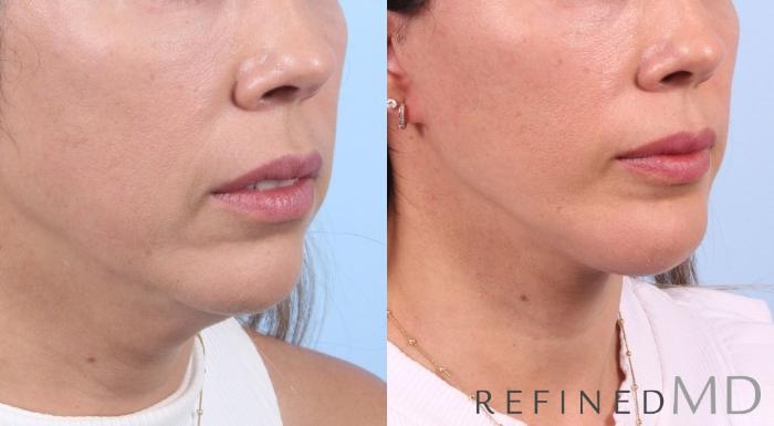 Before & After Facelift Case 1080 View 1 View in Los Gatos & San Jose, CA