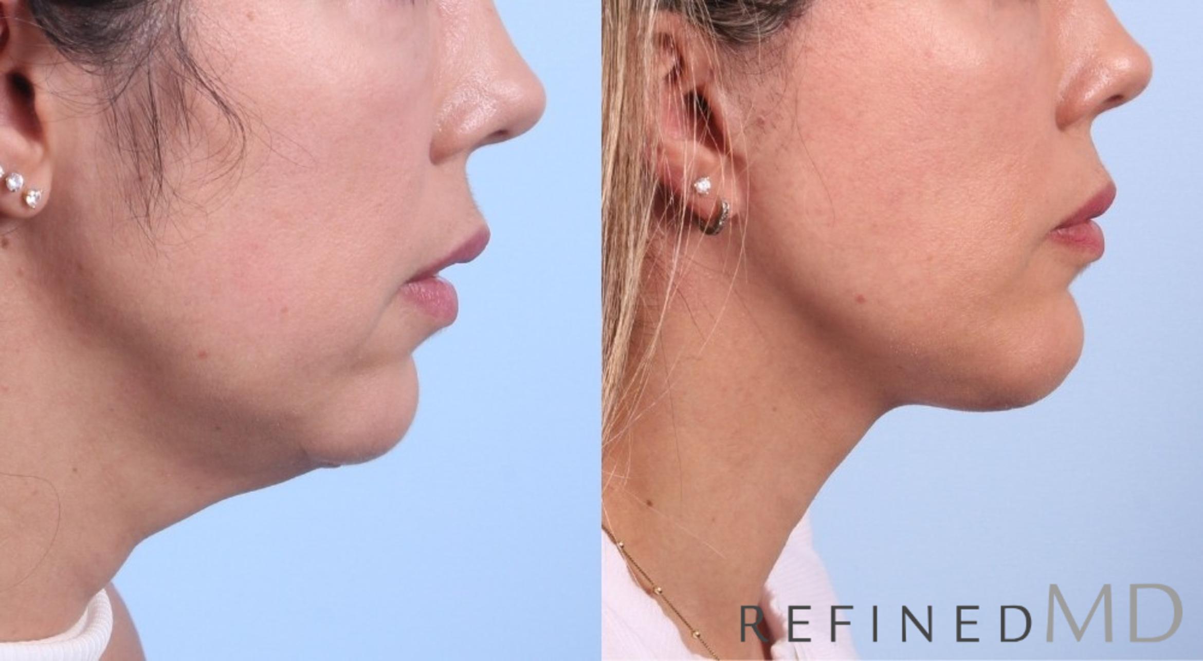 Before & After Facelift Case 1080 View 2 View in Los Gatos & San Jose, CA
