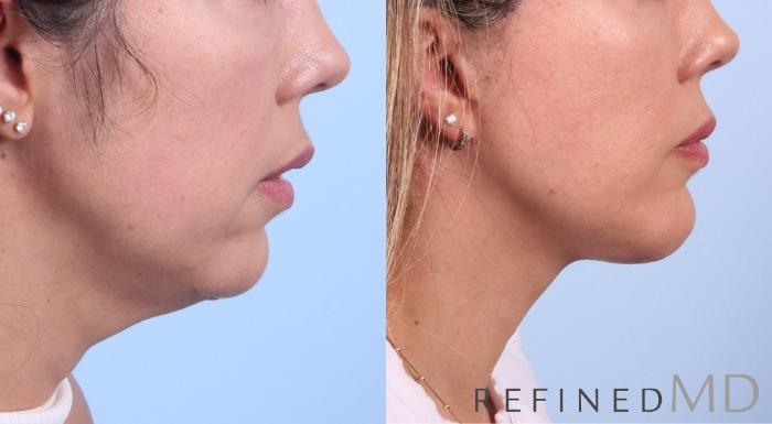 Before & After Facelift Case 1080 View 2 View in Los Gatos & San Jose, CA