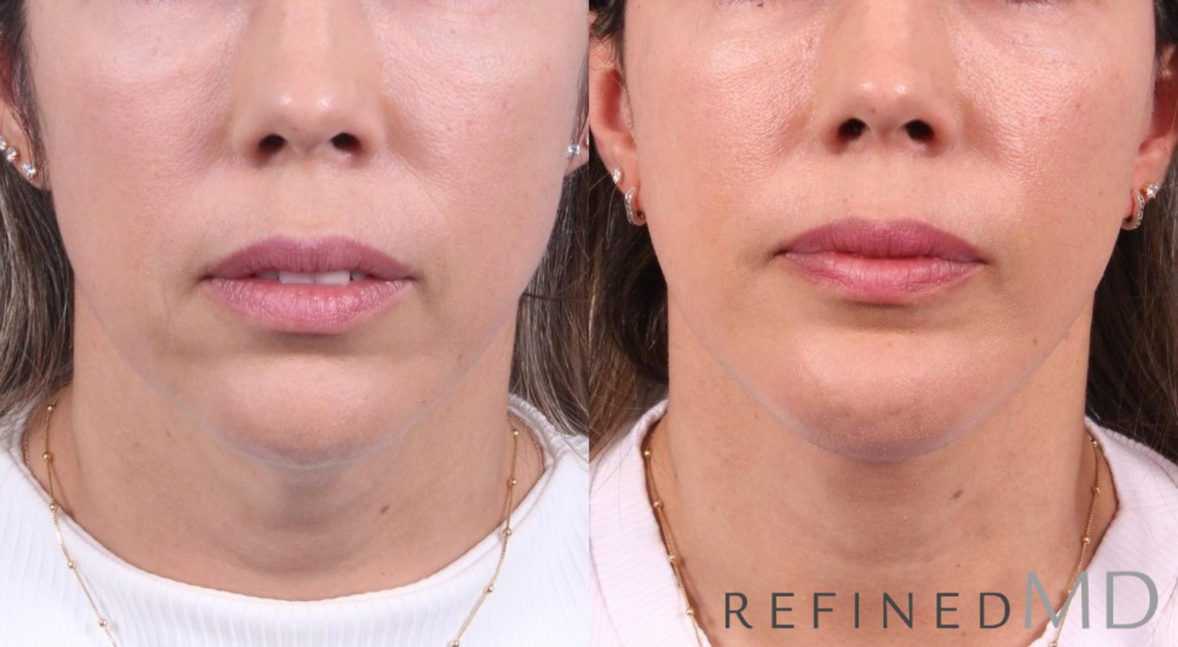 Before & After Facelift Case 1080 View 3 View in Los Gatos & San Jose, CA
