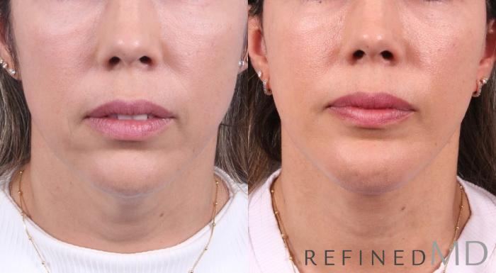 Before & After Facelift Case 1080 View 3 View in Los Gatos & San Jose, CA