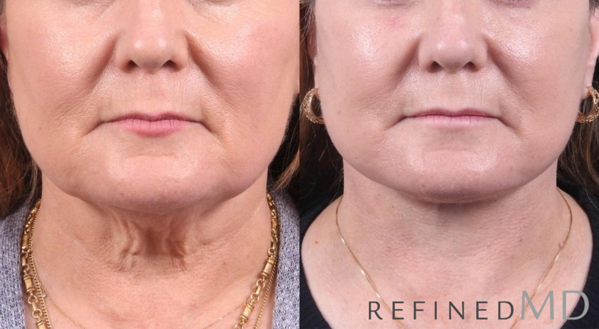 Before & After Facelift Case 1081 View 1 View in Los Gatos & San Jose, CA