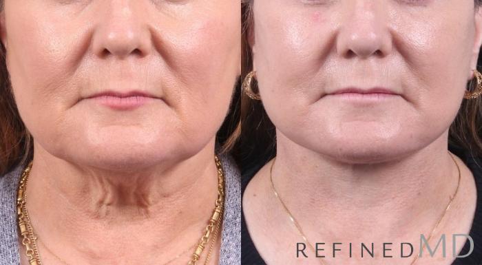 Before & After Facelift Case 1081 View 1 View in Los Gatos & San Jose, CA